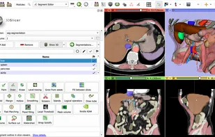 Image segmentation
Create surgical plans, create high-quality atlases, or training data sets for deep learning using the Segment Editor module. 