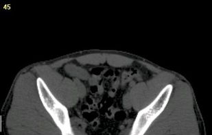 Step 1. Original CT image