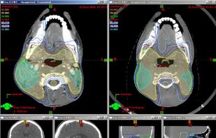 Varian Eclipse screenshot 3