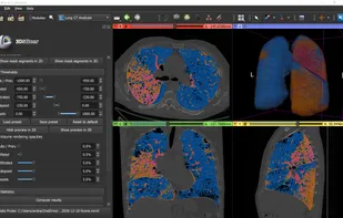 Lung CT analysis for COVID-19
LungCTAnalyzer extension offers automated lung segmentation and quantative analysis for COVID-19 cases.