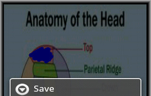 Migraine Pic screenshot 2