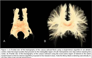 Tractography
UKFTractography is a module for computing tractography of DWI images using an unscented Kalman filter. Because of its 2-tensor algorithm, it is able to model fiber crossings and capture many more fibers than a single tensor algorithm. 