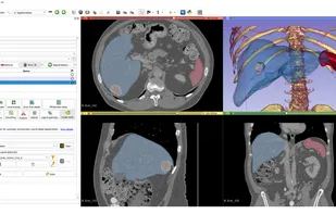 AI-assisted segmentation
AI-assisted annotation tools can automatically segment anatomical structures using pre-trained or custom models.