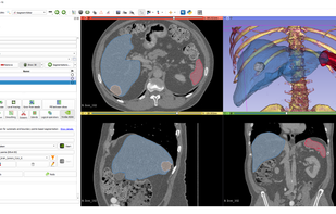 AI-assisted segmentation
AI-assisted annotation tools can automatically segment anatomical structures using pre-trained or custom models.