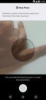1. Take an image of a lesion.